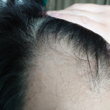 Anti Hair Loss Serum Quinine & Edelweiss
