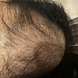 Anti-Hair Loss Serum